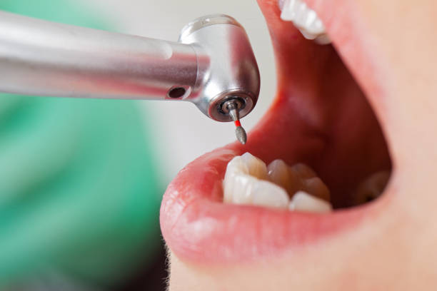 Best Emergency Tooth Extraction in Cotter, AR
